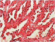 Papillary RCC type2
